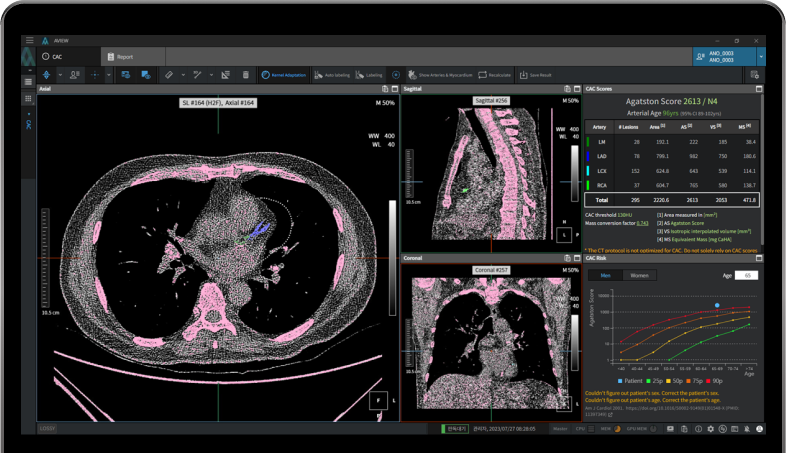 AI 기반 관상동맥석회화 분석 소프트웨어 흉부 CT 영상 분석