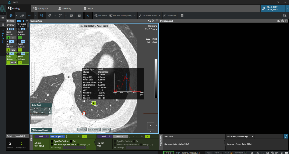 aview LCS | Automated Matching of Follow-up with Previous Lung CT Scans Instantly Assess Nodule Changes