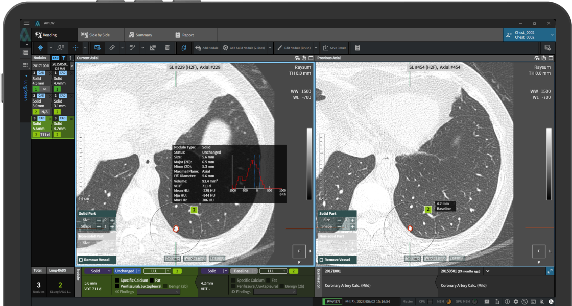 aview LCS | Automated Nodule Detection and Lung-RADS Calculation