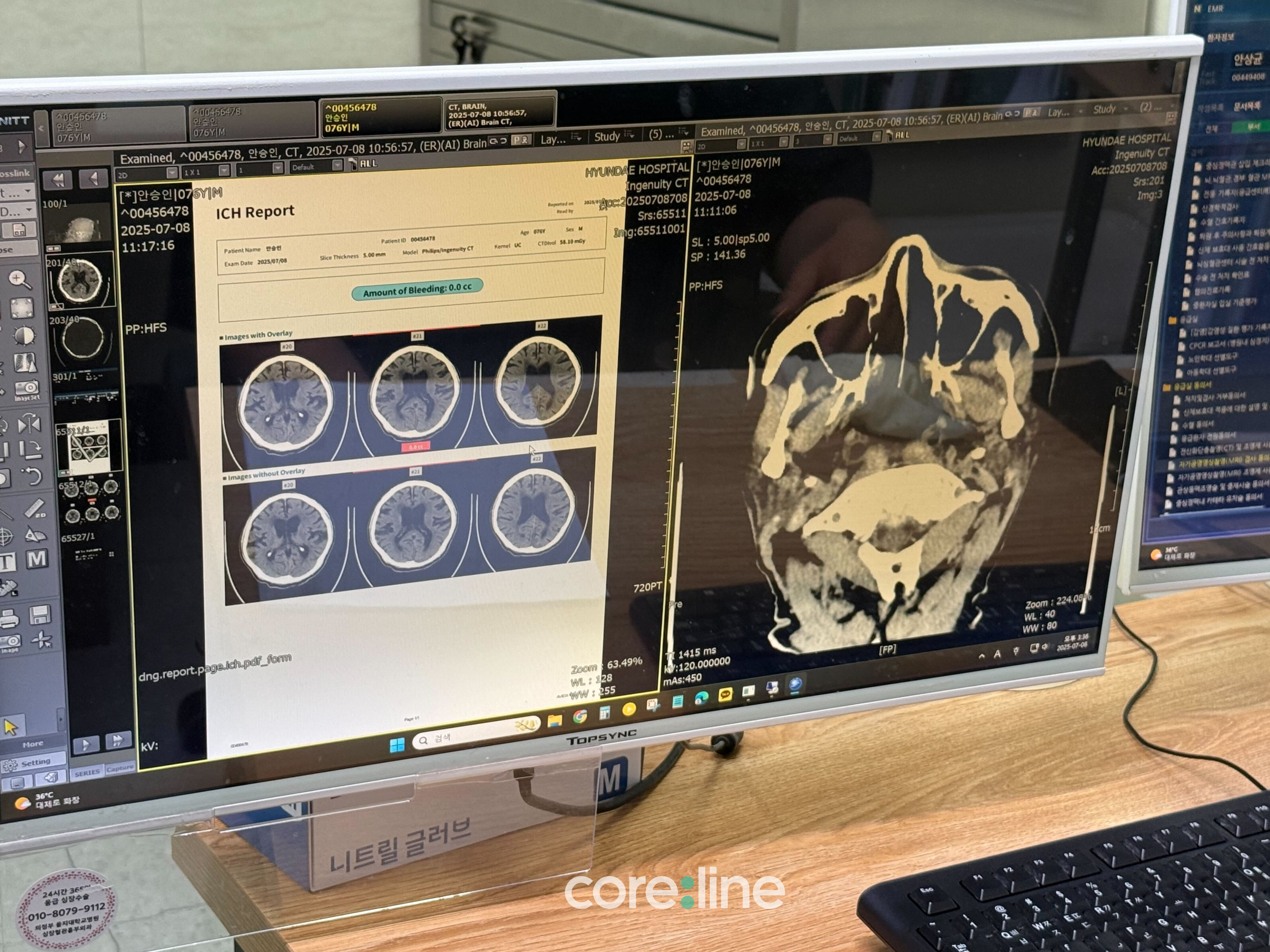 A medical monitor displays brain CT scans alongside an AI-generated ICH (intracerebral hemorrhage) report. On the left, the automated report shows multiple CT slice images with an indicated bleeding amount of “0.0 cc.” On the right, a detailed axial CT scan of the skull and facial structures is visible.