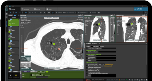 aview LCS PLUS | Lung Nodules Detection and Analysis