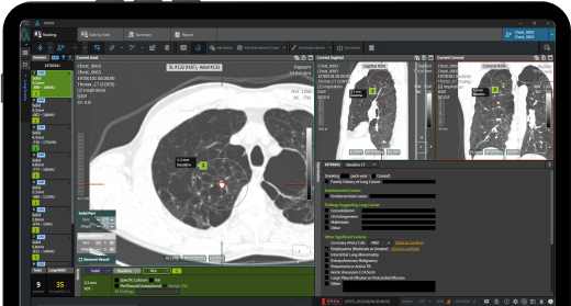 폐결절 검출 및 분석 이미지