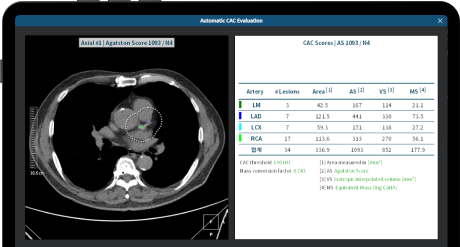 aview LCS PLUS | Detection of calcium in the coronary artery