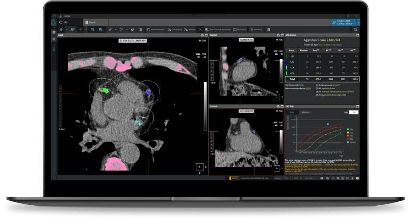 aview CAC | Automated COPD Analysis AI Solution