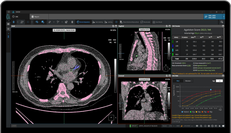 aview CAC | Analysis of chest CT images