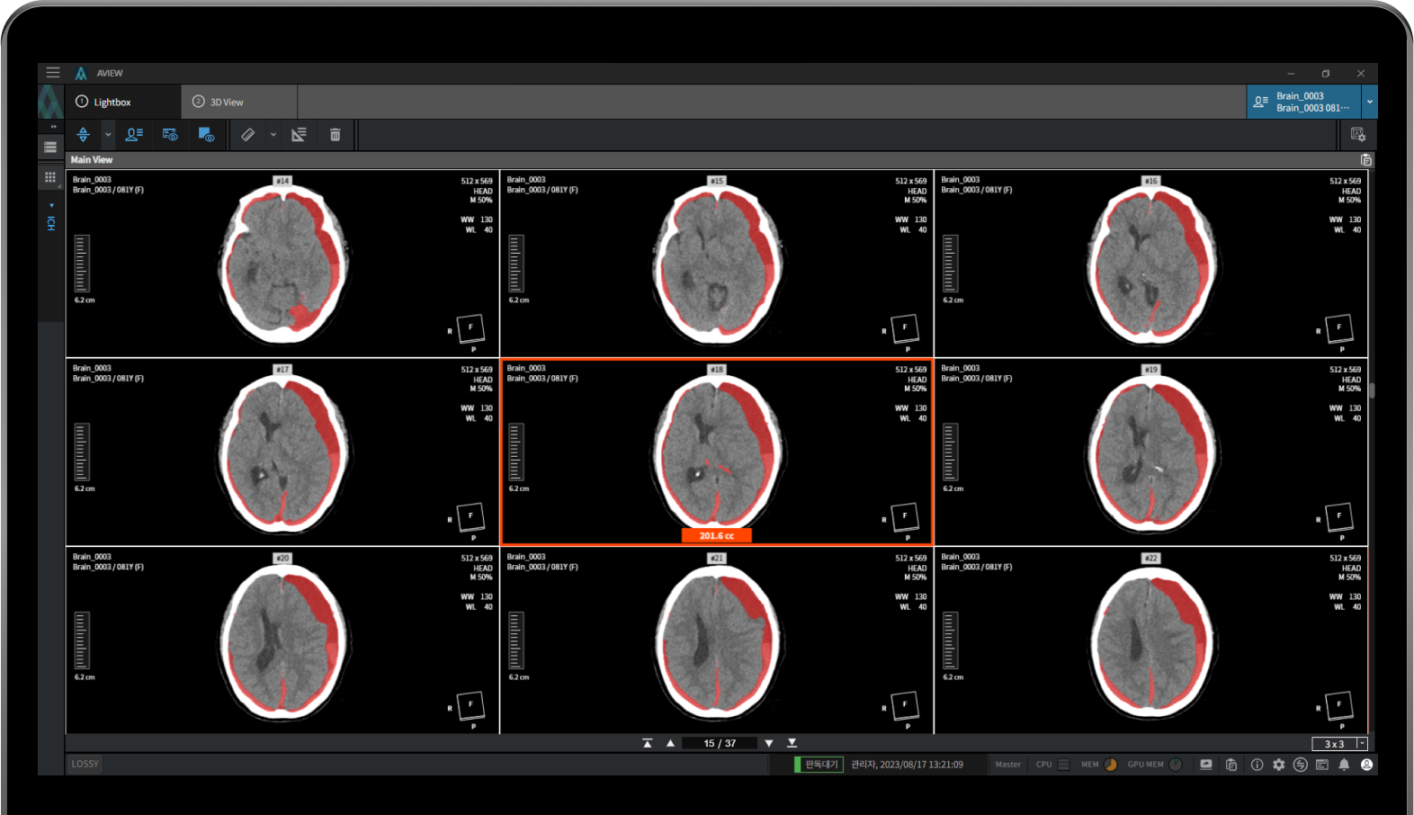 aview NeuroCAD Quick processing and automatic detection of brain hemorrhages