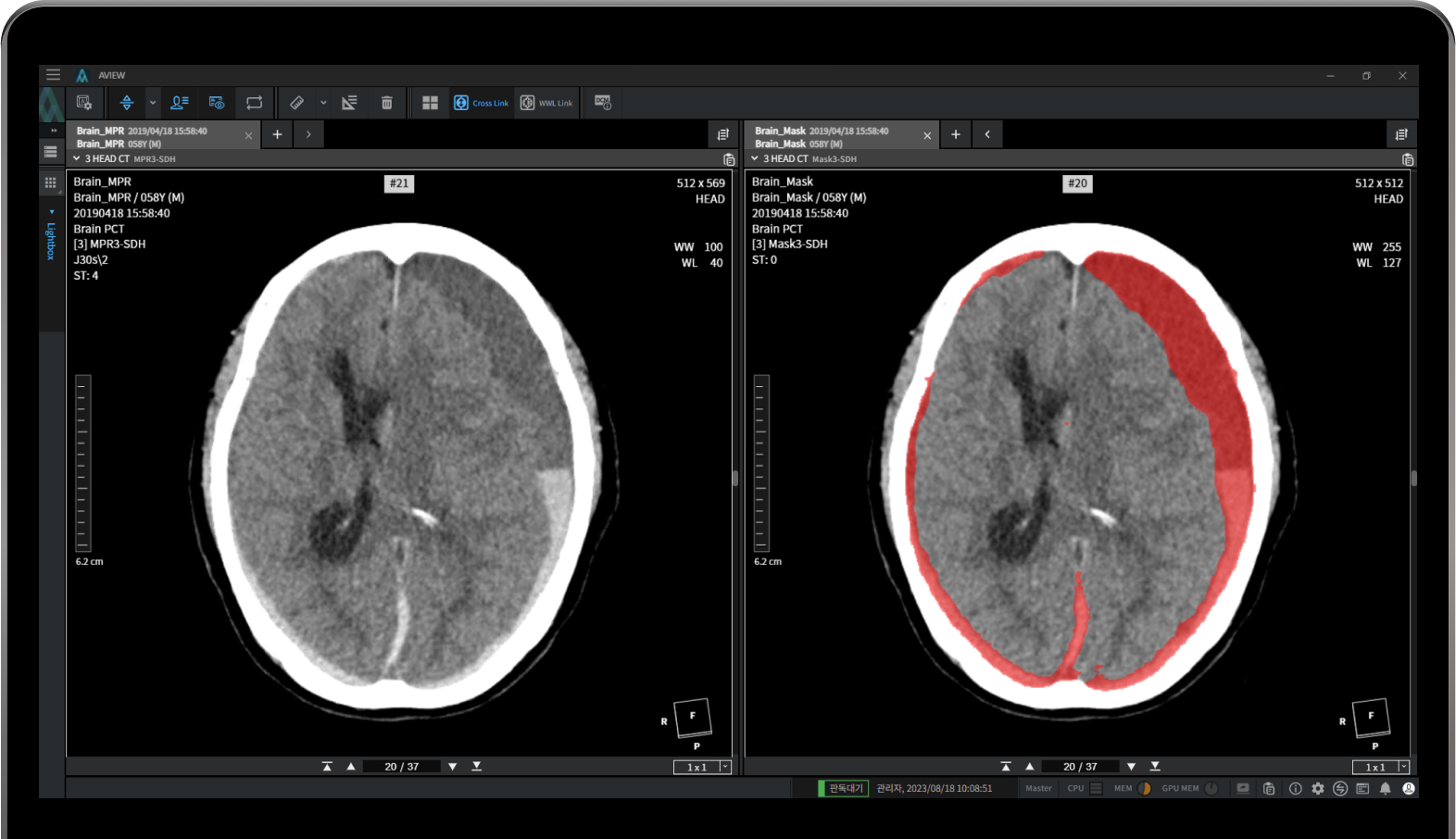aview NeuroCAD Quick processing and automatic detection of brain hemorrhages