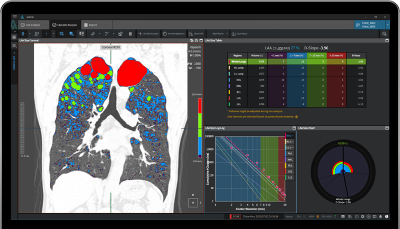 aview COPD | Emphysema Cluster Analysis