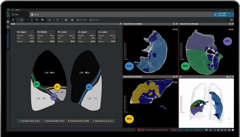 aview COPD | Analysise of Fissure Completeness (optional)