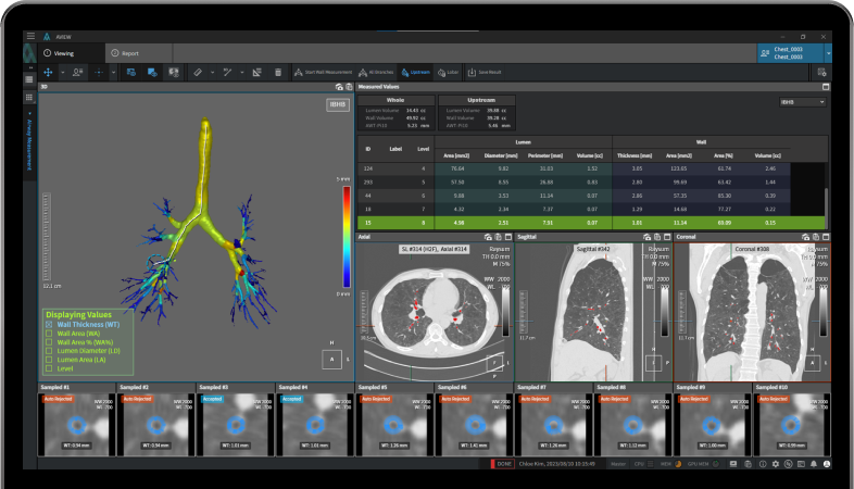 aview COPD | Airway analysis