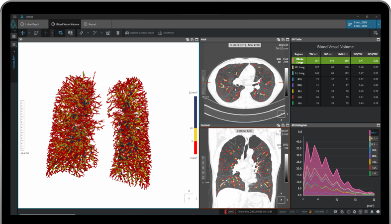 aview COPD | Pulmonary vascular analysis