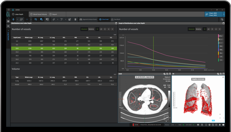 aview COPD | Pulmonary vascular analysis