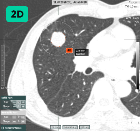 aview LCS | Detecting Nodules of Various Sizes, from Small to Large