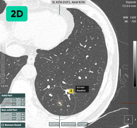 aview LCS | Detecting Nodules of Various Sizes, from Small to Large