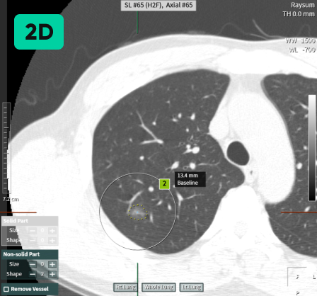 aview LCS | Detecting Nodules of Various Sizes, from Small to Large