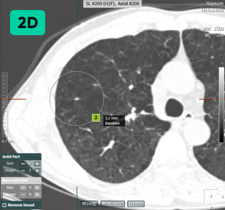 aview LCS | Detecting Nodules of Various Sizes, from Small to Large