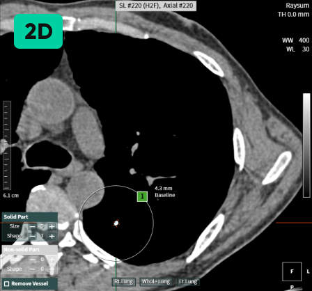 aview LCS | Detecting Nodules of Various Sizes, from Small to Large