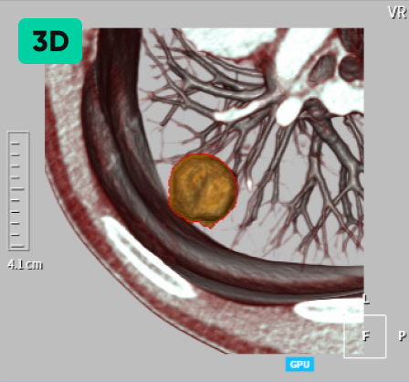 결절 자동 검출 & 계산 3D 이미지