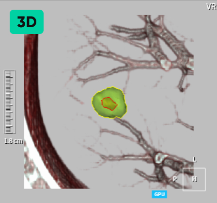 aview LCS | Detecting Nodules of Various Sizes, from Small to Large