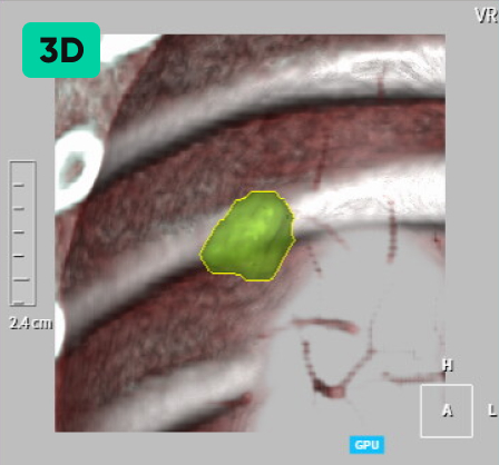 결절 자동 검출 & 계산 3D 이미지