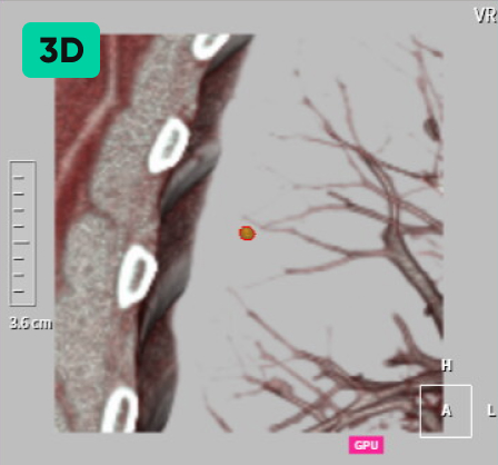 결절 자동 검출 & 계산 3D 이미지