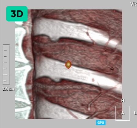 aview LCS | Detecting Nodules of Various Sizes, from Small to Large