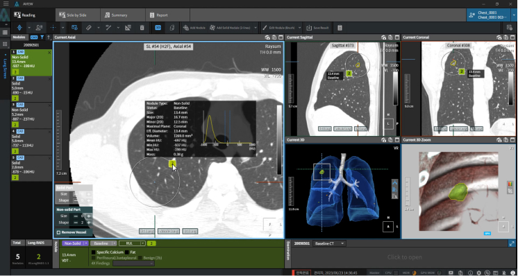 aview LCS | Automated Nodule Detection and Lung-RADS Calculation