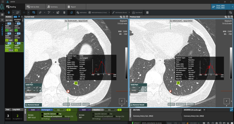 aview LCS | Automated Matching of Follow-up with Previous Lung CT Scans Instantly Assess Nodule Changes