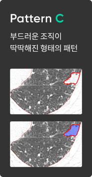 간질성 폐질환 패턴 분석 이미지