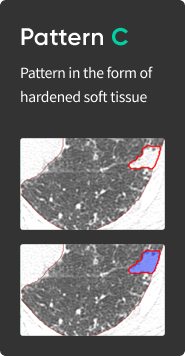 aview Lung Texture | Patterns Analysis in Interstitial Lung Disease