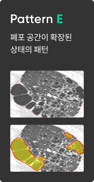 간질성 폐질환 패턴 분석 이미지