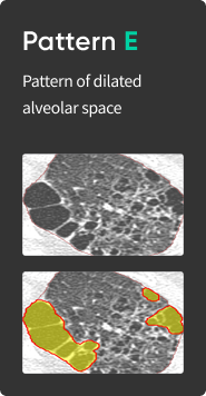 aview Lung Texture | Patterns Analysis in Interstitial Lung Disease