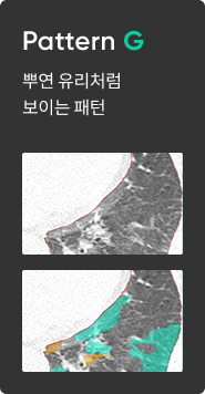 간질성 폐질환 패턴 분석 이미지