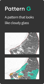 aview Lung Texture | Patterns Analysis in Interstitial Lung Disease