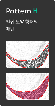 간질성 폐질환 패턴 분석 이미지