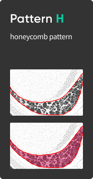 aview Lung Texture | Patterns Analysis in Interstitial Lung Disease