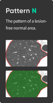 aview Lung Texture | Patterns Analysis in Interstitial Lung Disease