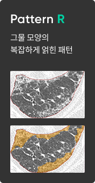 간질성 폐질환 패턴 분석 이미지