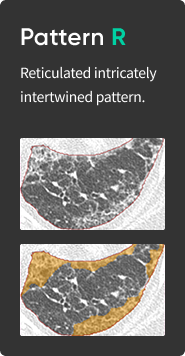 aview Lung Texture | Patterns Analysis in Interstitial Lung Disease