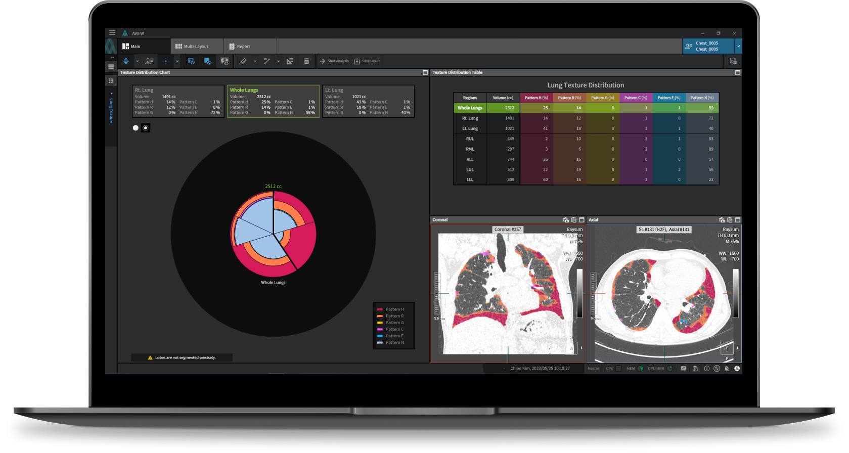 aview Lung Texture | Interstitial Lung Disease Pattern Analysis Solution