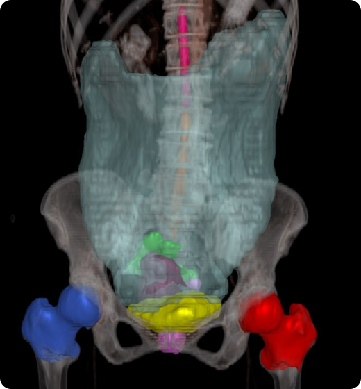 aview Modeler Automatically segment and contour organs with aview RT ACS Pelvis