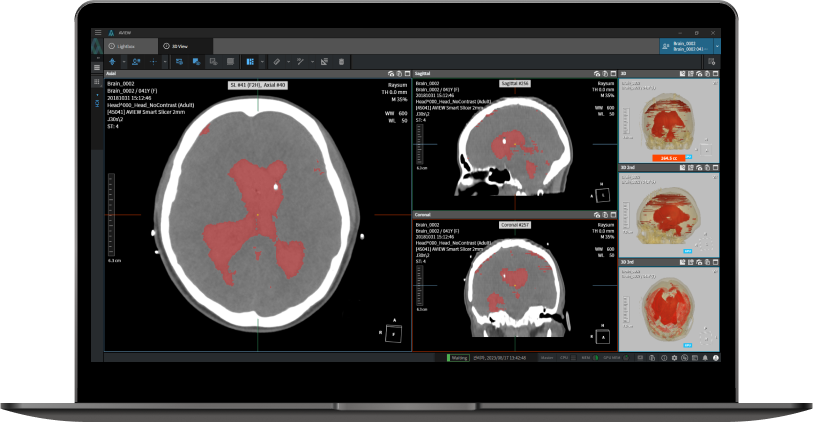 AI 기반 뇌출혈 검출 · 진단 보조 소프트웨어