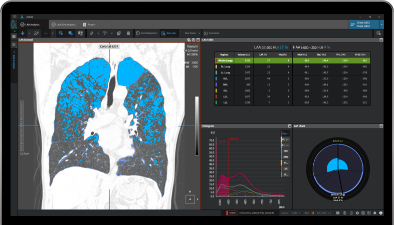 aview COPD | Emphysema analysis