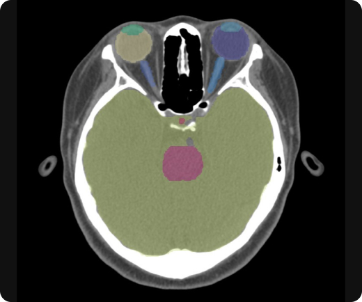 aview RT ACS Automate organ segmentation Head & Neck