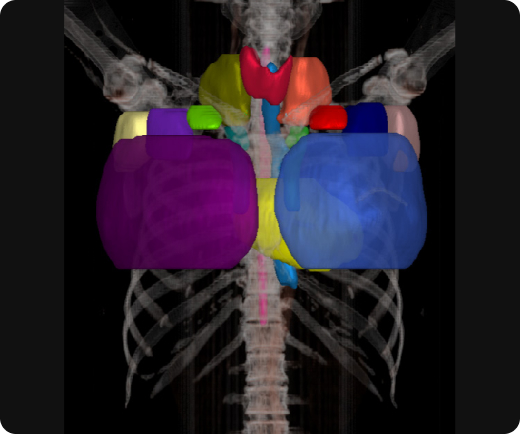 aview RT ACS Automate organ segmentation Breast