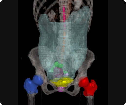 aview RT ACS Automate organ segmentation Pelvis