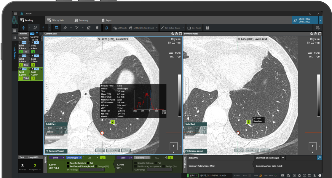 aview Lung Texture | Patterns Analysis in Interstitial Lung Disease | Multi-Layout