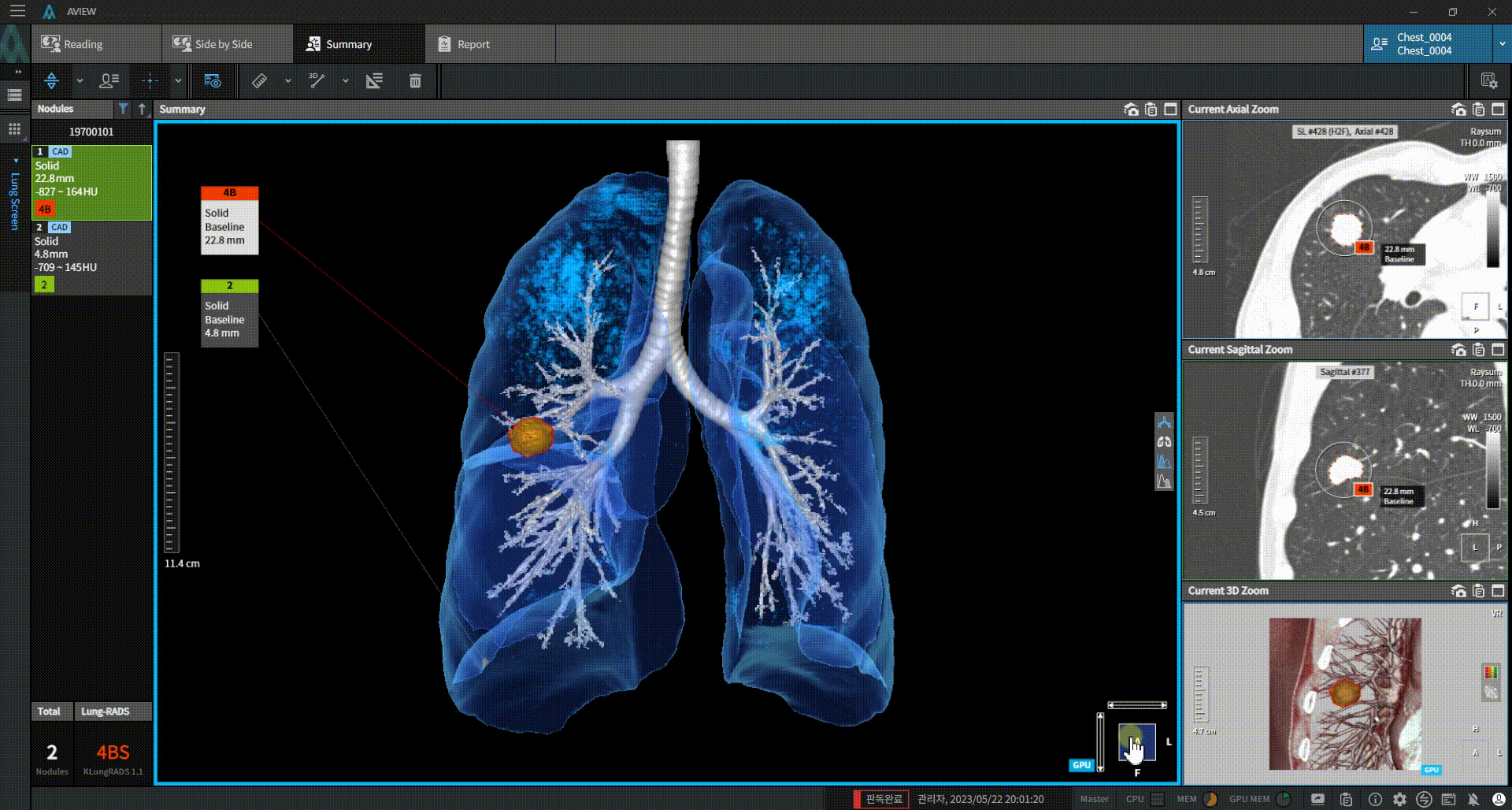aview LCS | CT Findings are visualized in 3D, User-Friendly Viewer for Medical Professionals and Patients