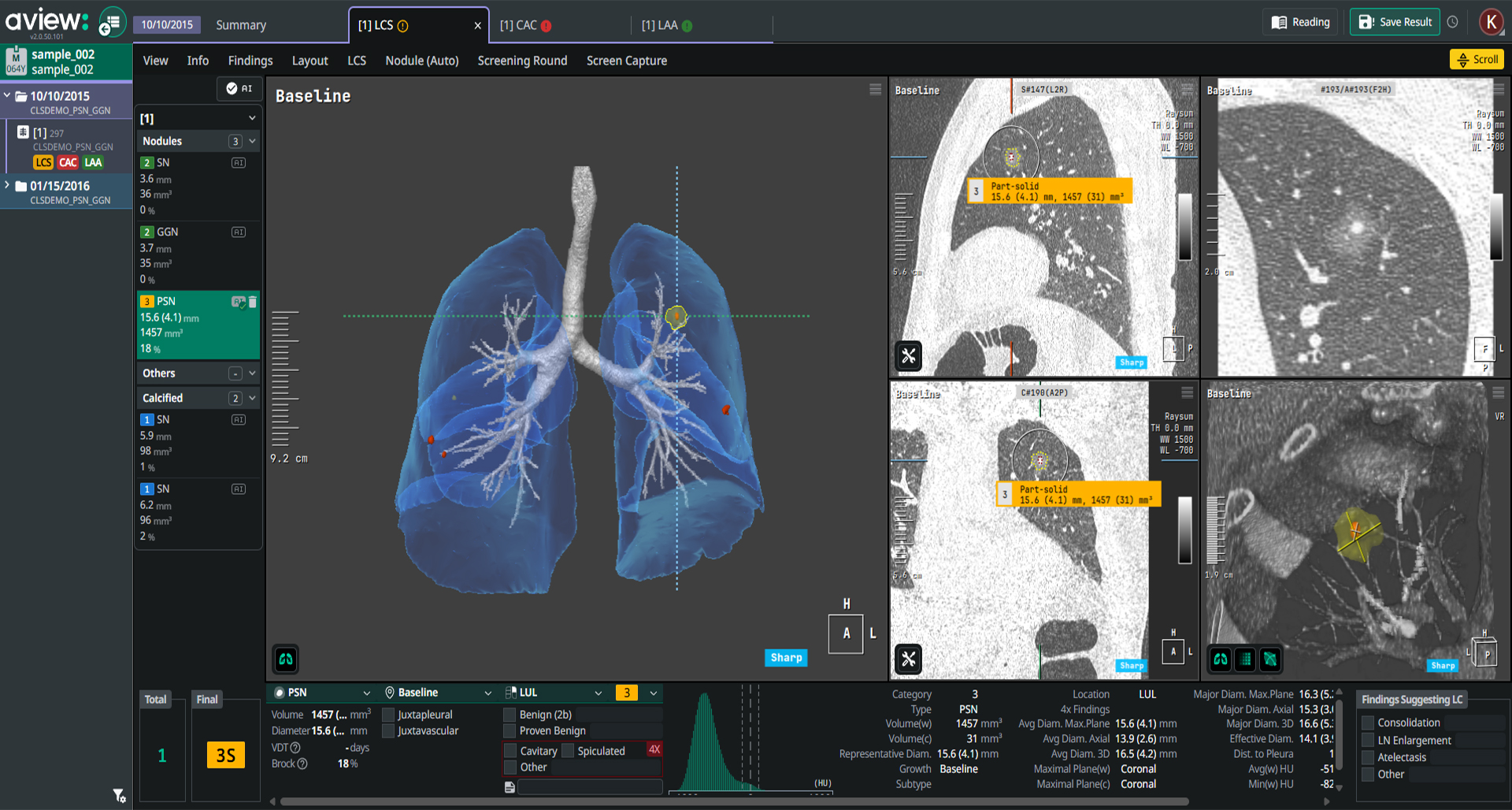 aview LCS | CT Findings are visualized in 3D, User-Friendly Viewer for Medical Professionals and Patients