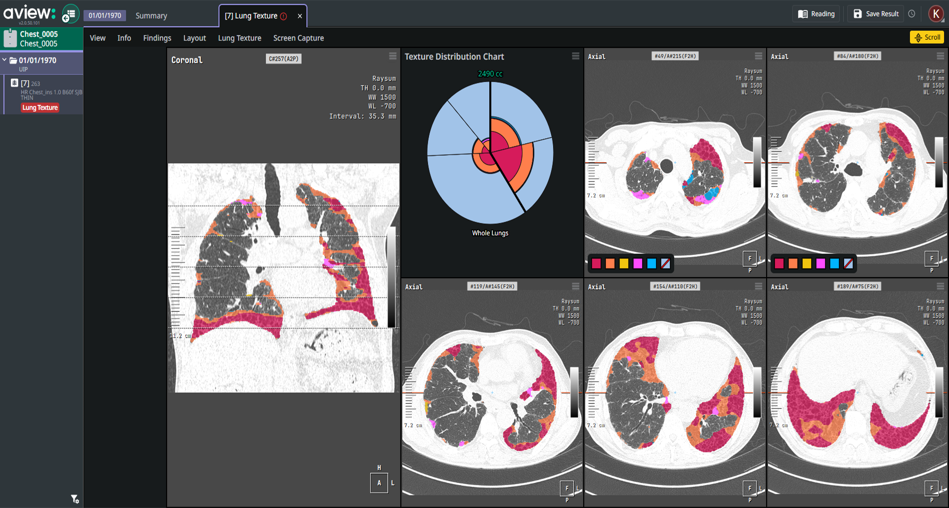 간질성 폐질환 패턴 분석 Multi-Layout